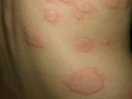 Urticaria